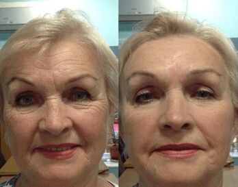 опит с използването на крем Годжи - лична снимка преди и след