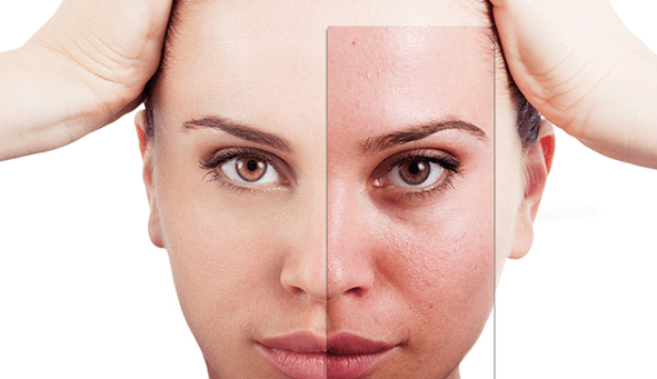 фракционното подмладяване премахва основните естетически дефекти по лицето