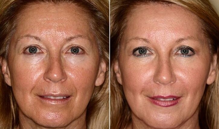 преди и след подмладяване на кожата на лицето у дома
