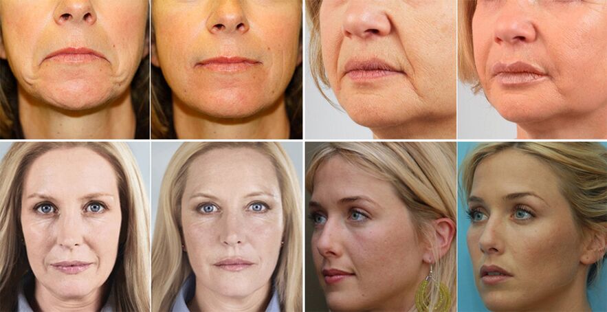 снимки на жени преди и след подмладяване на кожата на лицето