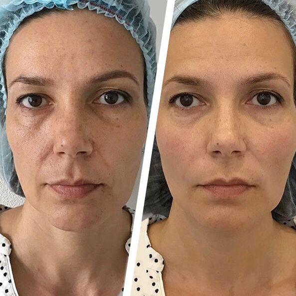 снимка на лицето преди и след лазерно подмладяване